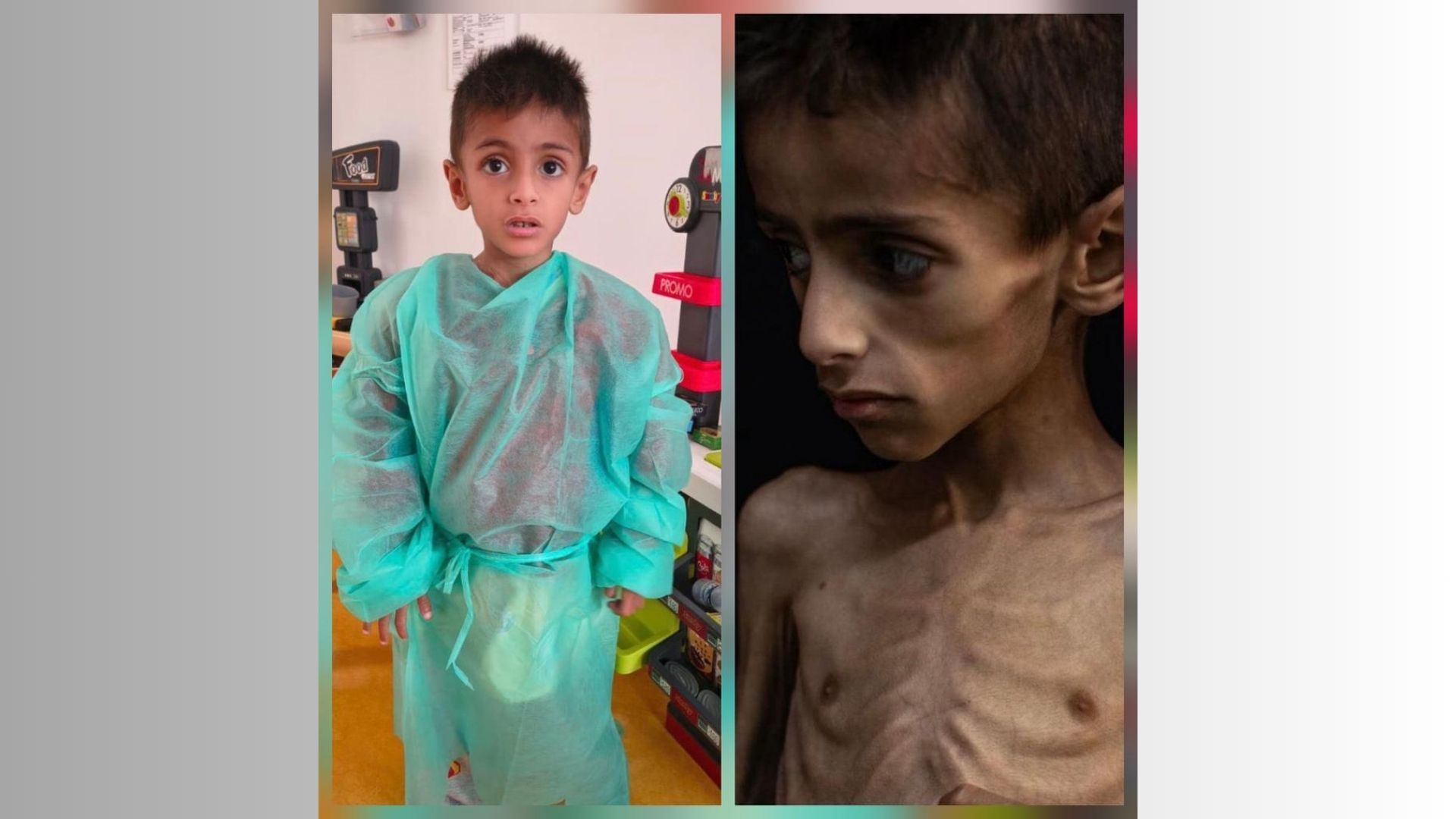 Il corpo del piccolo Osama usato contro Israele: ma soffre di una malattia genetica