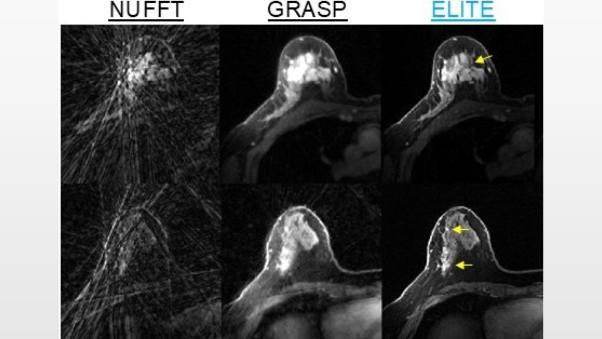 AI e Risonanza Magnetica: una svolta per la diagnosi del tumore al seno